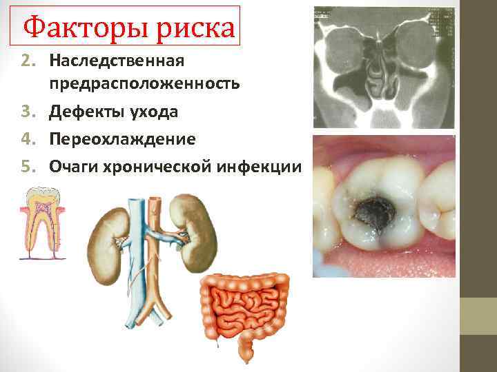 Факторы риска 2. Наследственная предрасположенность 3. Дефекты ухода 4. Переохлаждение 5. Очаги хронической инфекции
