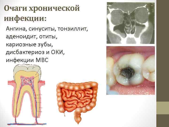 Очаги хронической инфекции: Ангина, синуситы, тонзиллит, аденоидит, отиты, кариозные зубы, дисбактериоз и ОКИ, инфекции