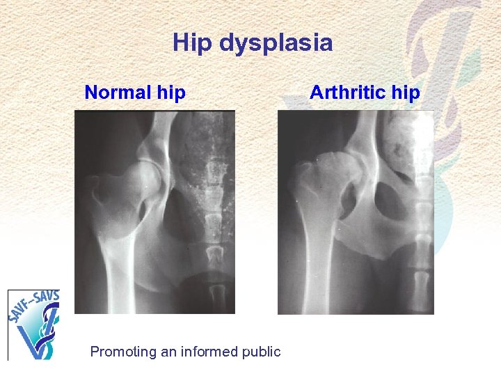 Hip dysplasia Normal hip Promoting an informed public Arthritic hip 