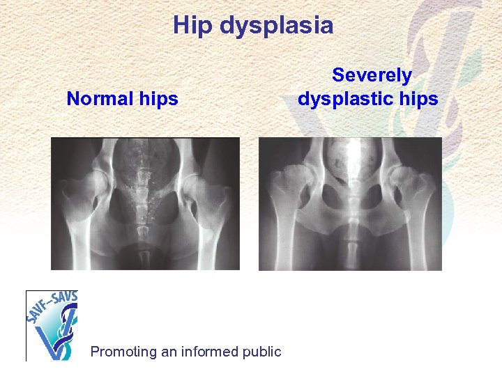 Hip dysplasia Normal hips Promoting an informed public Severely dysplastic hips 