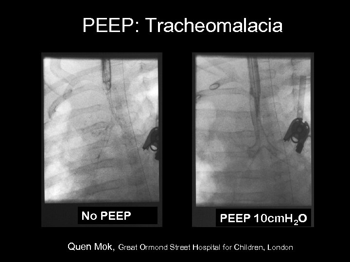 PEEP: Tracheomalacia No PEEP 10 cm. H 2 O Quen Mok, Great Ormond Street