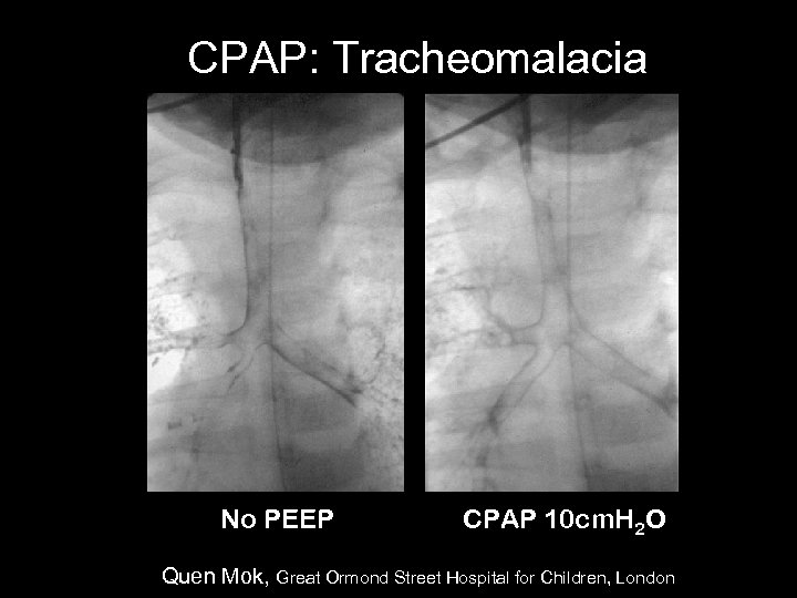 CPAP: Tracheomalacia No PEEP CPAP 10 cm. H 2 O Quen Mok, Great Ormond