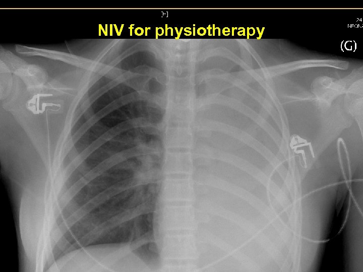 NIV for physiotherapy 