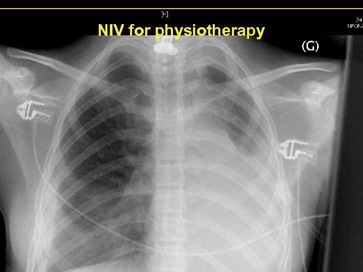 NIV for physiotherapy 