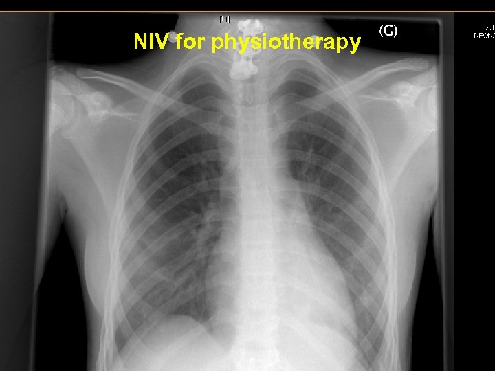 NIV for physiotherapy 