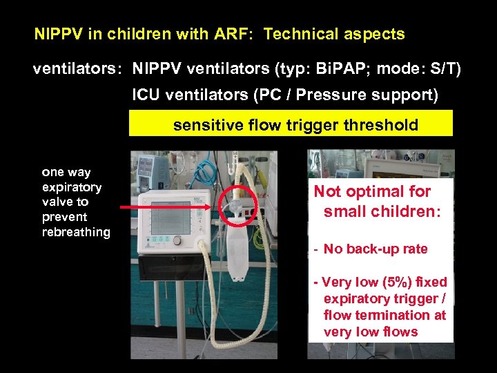 NIPPV in children with ARF: Technical aspects ventilators: NIPPV ventilators (typ: Bi. PAP; mode: