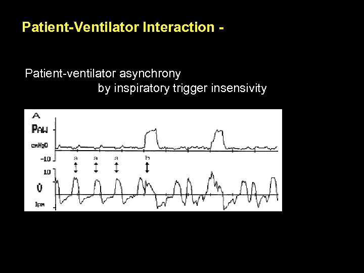 Patient-Ventilator Interaction Patient-ventilator asynchrony by inspiratory trigger insensivity 