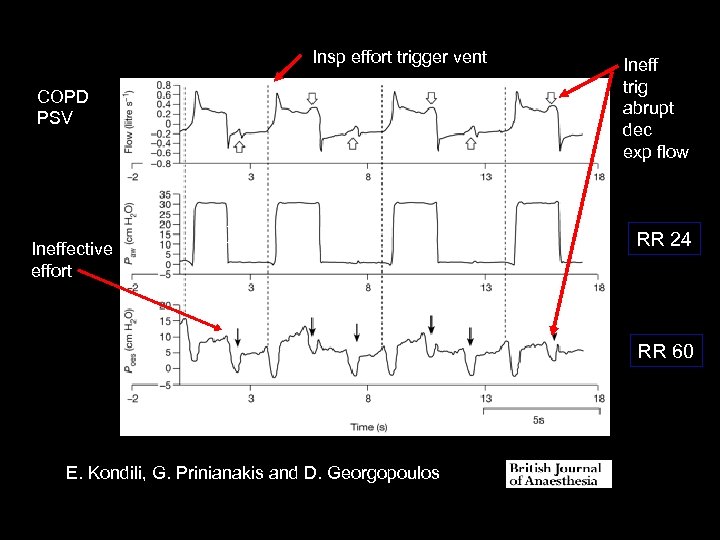 Insp effort trigger vent COPD PSV Ineffective effort (12) Ineff trig abrupt dec exp