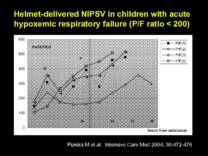 Helmet-delivered NIPSV in children with acute hypoxemic respiratory failure (P/F ratio < 200) Piastra