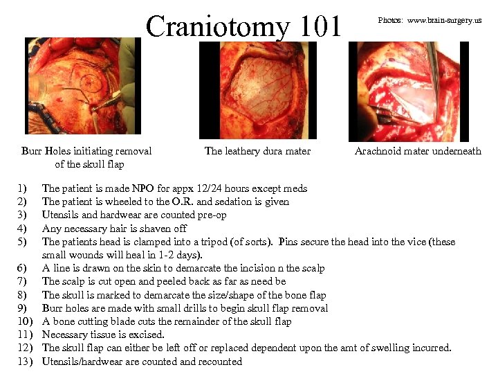 Craniotomy 101 Photos: www. brain-surgery. us Burr Holes initiating removal The leathery dura mater