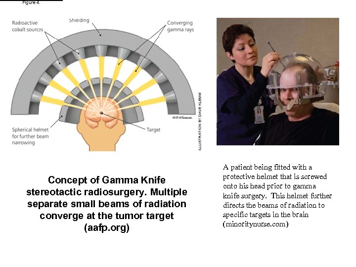 Figure 4. Concept of Gamma Knife stereotactic radiosurgery. Multiple separate small beams of radiation