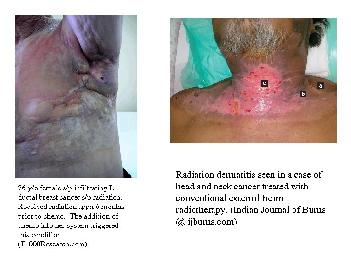 76 y/o female s/p infiltrating L ductal breast cancer s/p radiation. Received radiation appx