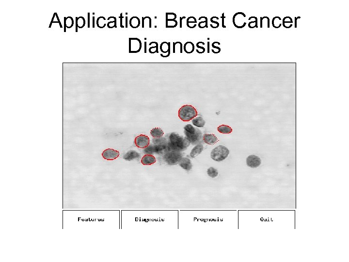 Application: Breast Cancer Diagnosis 