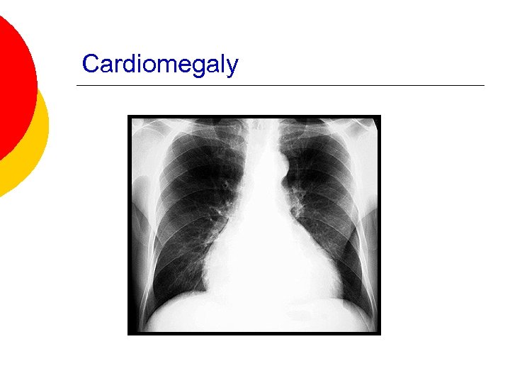 Cardiomegaly 