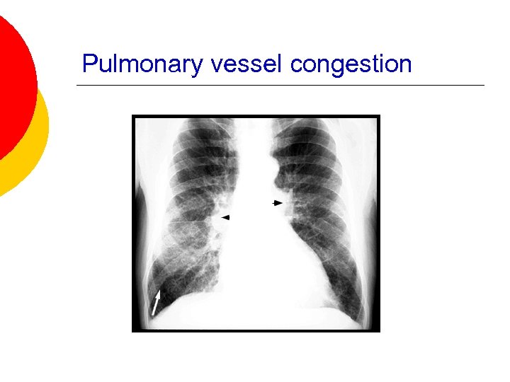 Pulmonary vessel congestion 