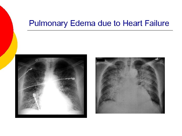 Pulmonary Edema due to Heart Failure 