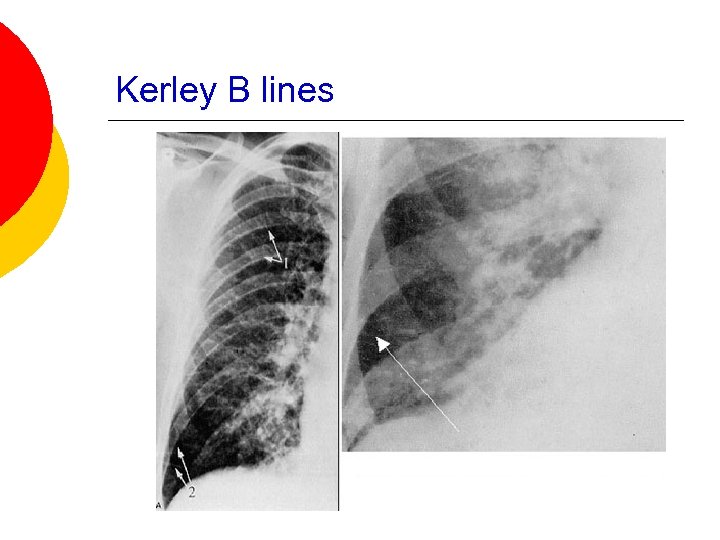 Kerley B lines 