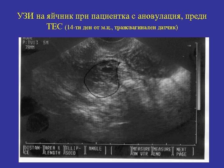 УЗИ на яйчник при пациентка с ановулация, преди ТЕС (14 -ти ден от м.