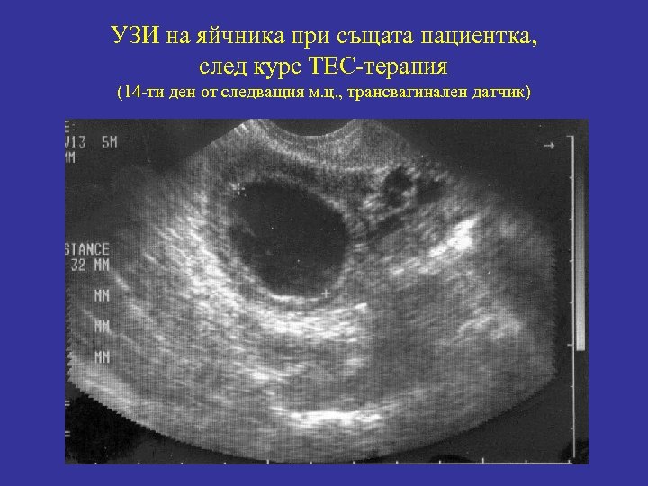 Гидросальпинкс схема лечения