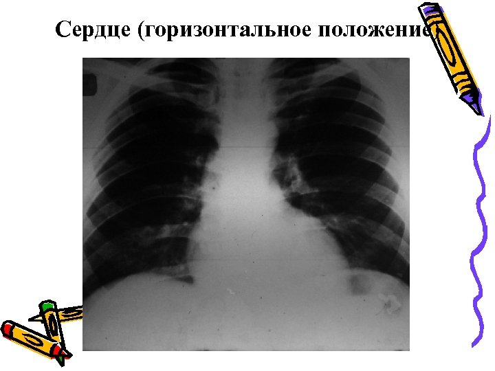 Сердце (горизонтальное положение) 