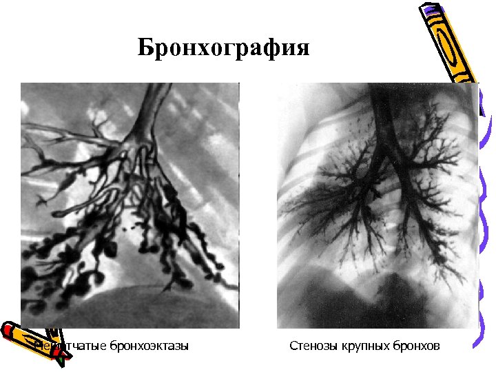 Бронхография Мешотчатые бронхоэктазы Стенозы крупных бронхов 