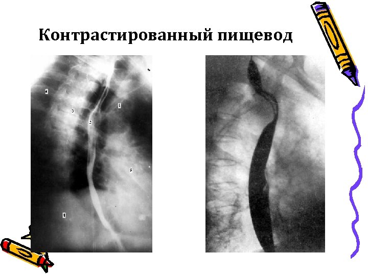 Контрастированный пищевод 