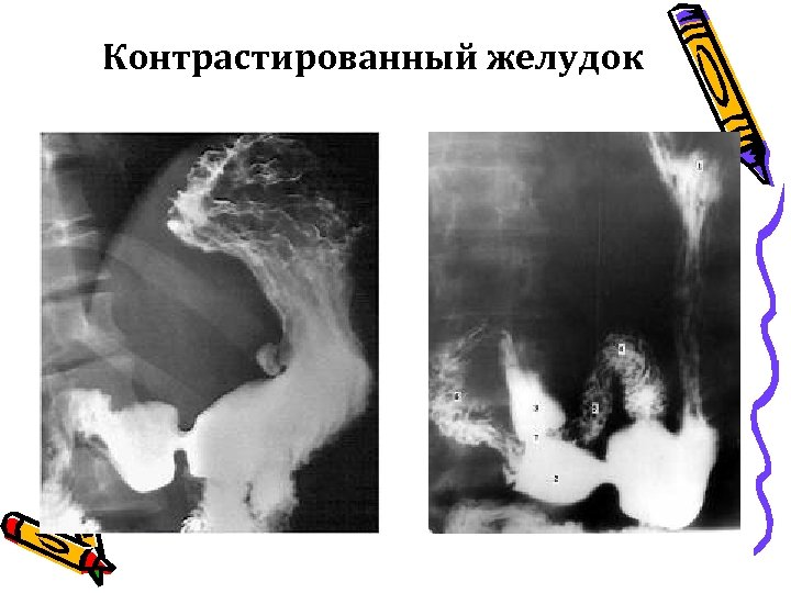 Контрастированный желудок 