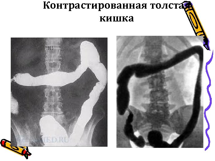 Контрастированная толстая кишка 