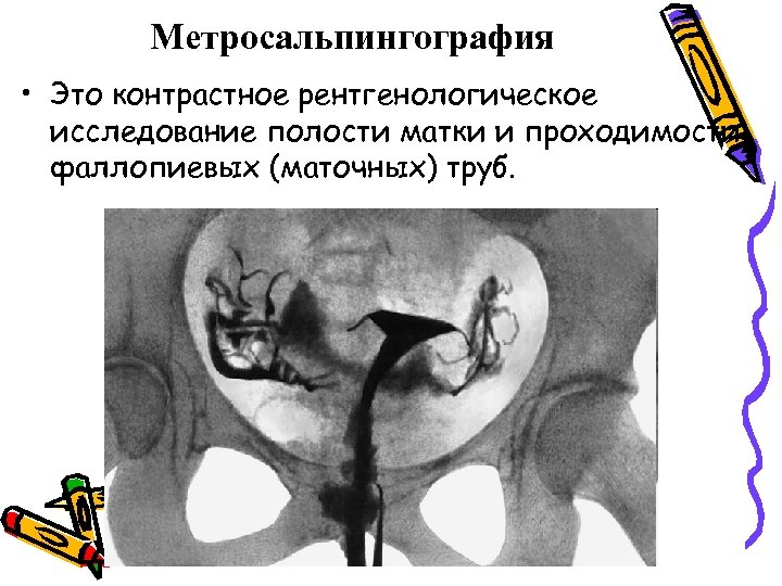 Метросальпингография • Это контрастное рентгенологическое исследование полости матки и проходимости фаллопиевых (маточных) труб. 