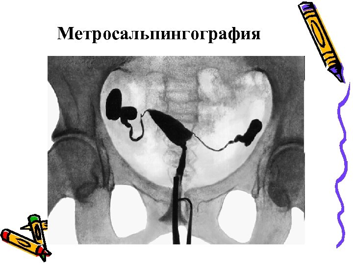 Метросальпингография 