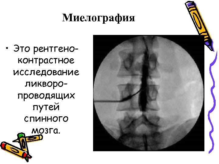 Миелография • Это рентгеноконтрастное исследование ликворопроводящих путей спинного мозга. 