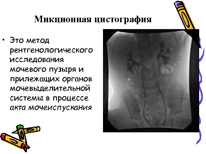 Микционная цистография • Это метод рентгенологического исследования мочевого пузыря и прилежащих органов мочевыделительной системы