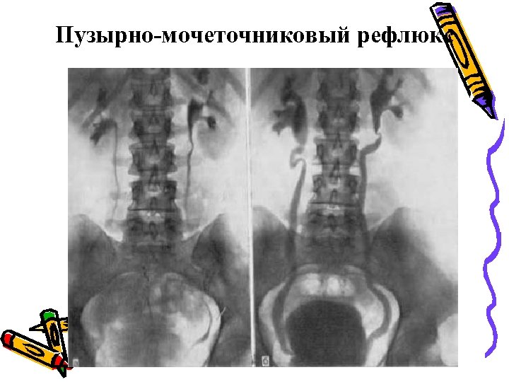 Пузырно-мочеточниковый рефлюкс 