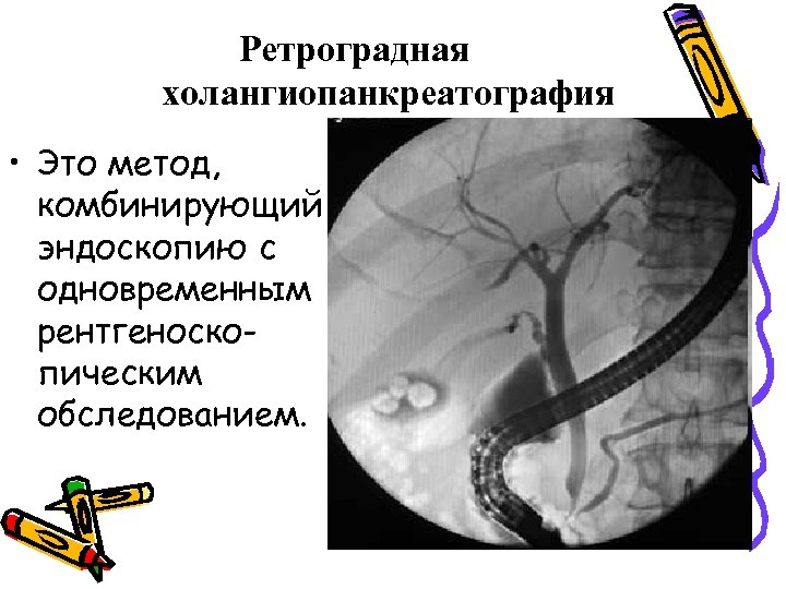 Ретроградная холангиопанкреатография • Это метод, комбинирующий эндоскопию с одновременным рентгеноскопическим обследованием. 