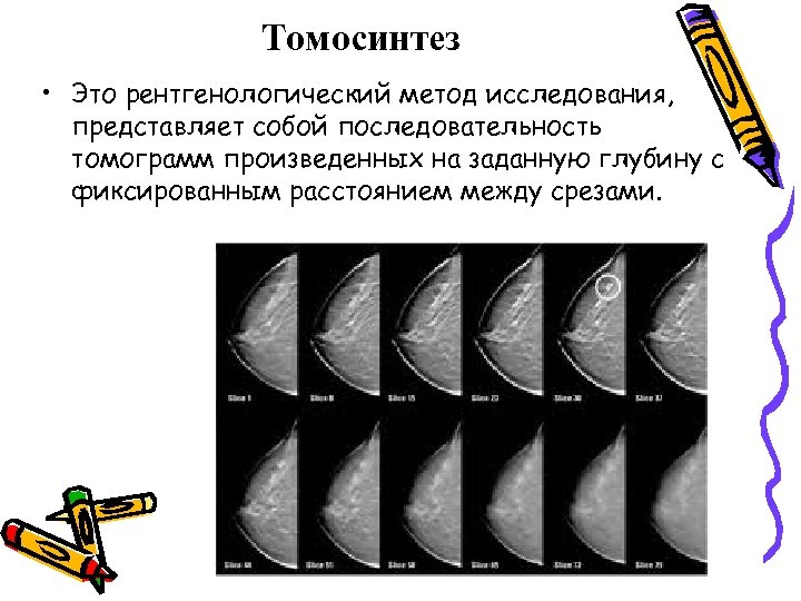 Томосинтез. Томосинтез методика исследования. Томосинтез молочных желез методика. Томосинтез в рентгенологии что это такое.