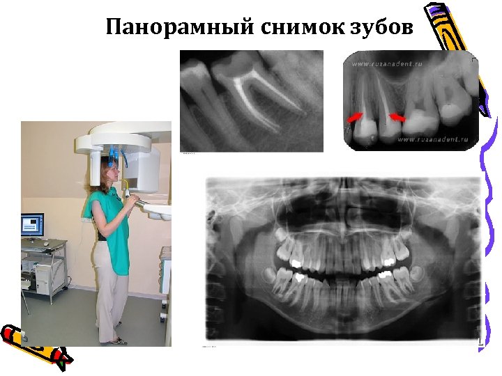 Панорамный снимок зубов 