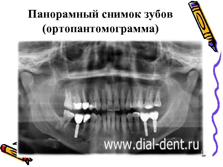 Панорамный снимок зубов (ортопантомограмма) 