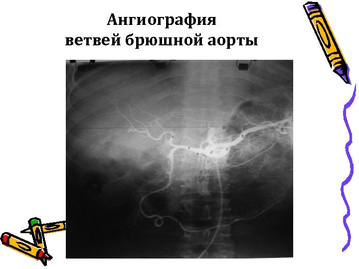 Ангиография ветвей брюшной аорты 