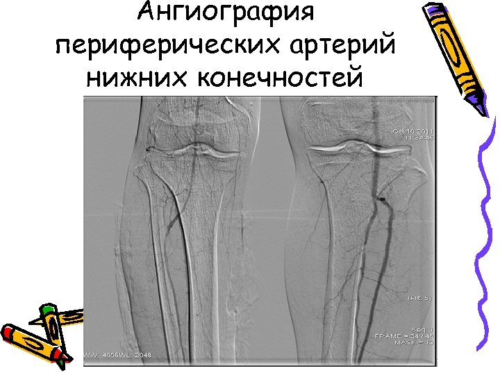 Ангиография периферических артерий нижних конечностей 