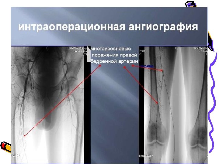 Тромбоз бедренной артерии