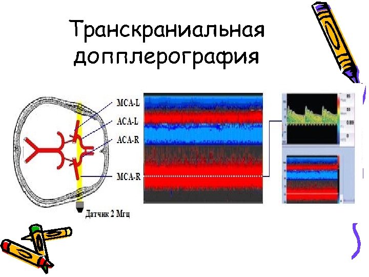 Транскраниальная допплерография 