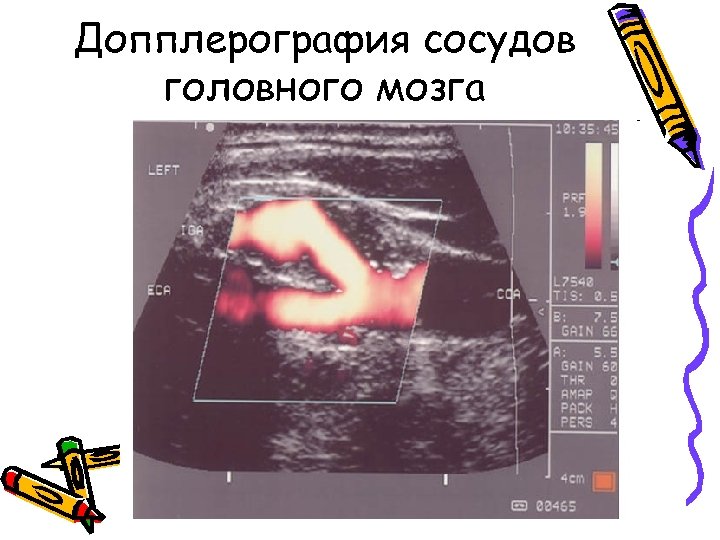 Допплерография сосудов головного мозга 