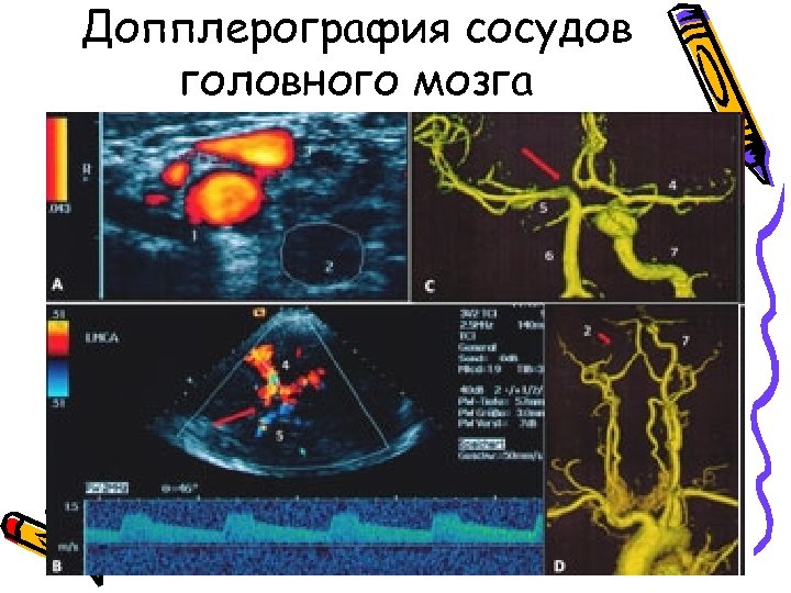 Сосуды головного мозга норма. Транскраниальная ультразвуковая допплерография. УЗИ допплерография сосудов головного мозга. Транскраниальная допплерография (ТКДГ. Ультразвуковая допплерография экстракраниальных сосудов.
