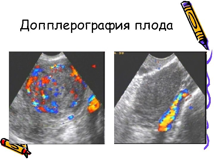 Допплерография плода 