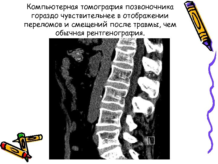 Компьютерная томография позвоночника гораздо чувствительнее в отображении переломов и смещений после травмы, чем обычная