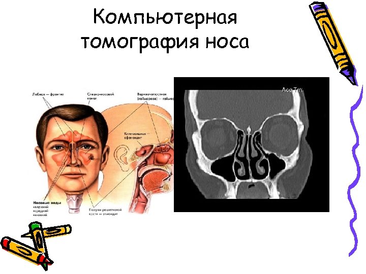 Компьютерная томография носа 