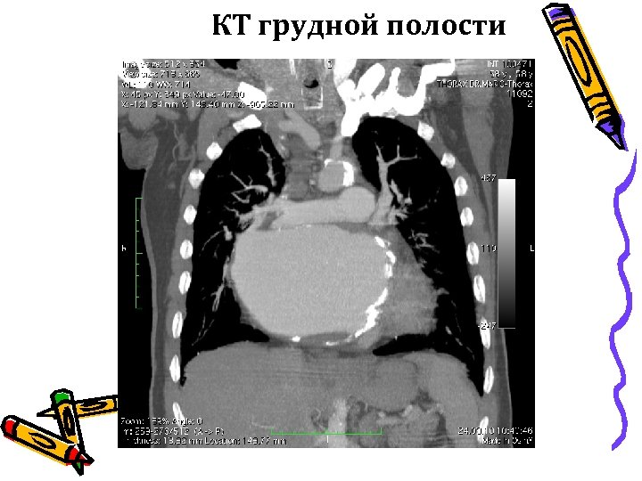 КТ грудной полости 