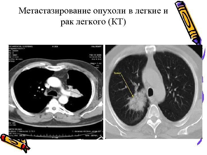 Метастазирование опухоли в легкие и рак легкого (КТ) 