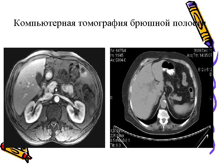 Компьютерная томография брюшной полости 