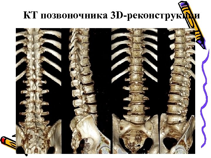 КТ позвоночника 3 D-реконструкции 